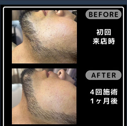ヒゲ脱毛の初回来店時と4回施術1ヶ月後を比較したフェイスラインの施術事例写真