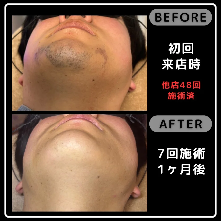 他店48回施術後の初回来店時とReyzの7回施術1ヶ月後を比較したあご下の写真