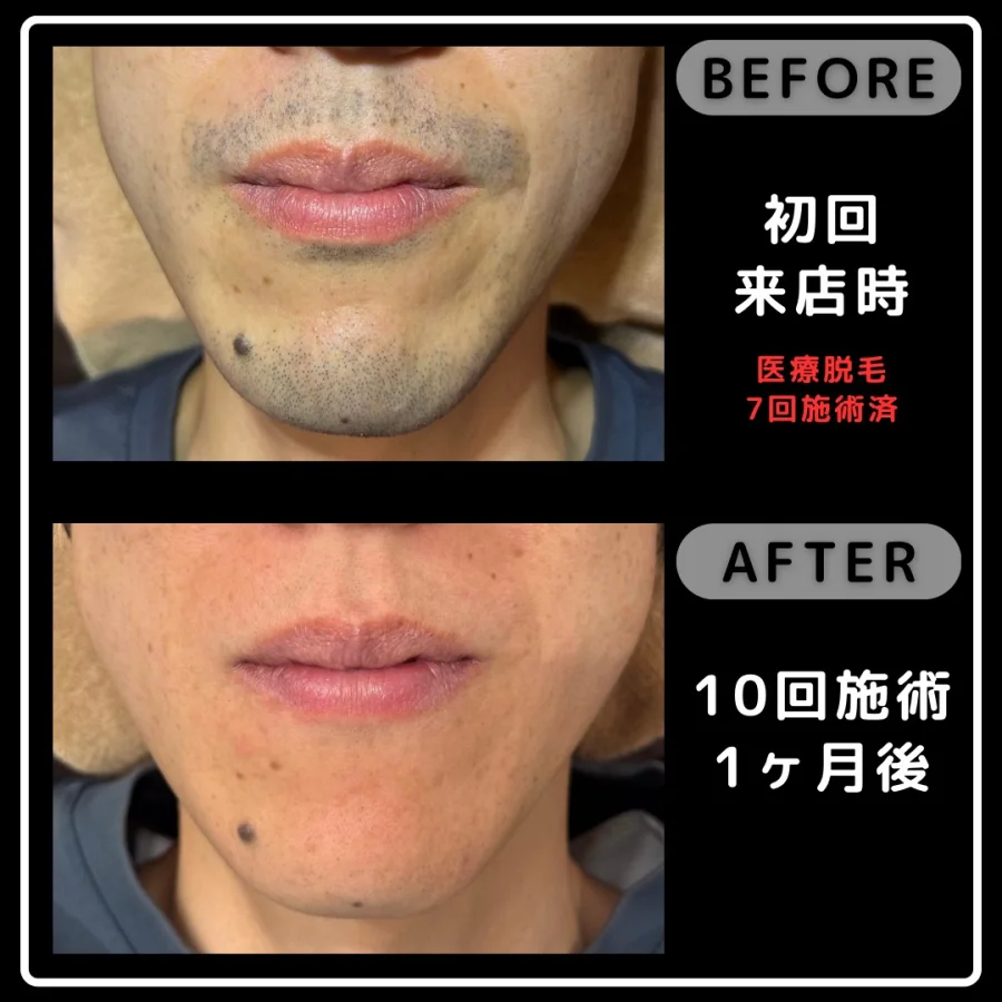 医療脱毛7回施術後の初回来店時とReyzの10回施術1ヶ月後を比較した正面の写真