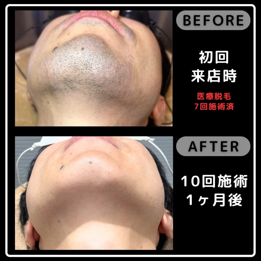 医療脱毛7回施術後の初回来店時とReyzの10回施術1ヶ月後を比較したあご下の写真