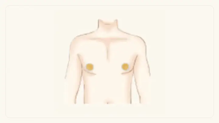 乳輪まわりの脱毛範囲イメージ
