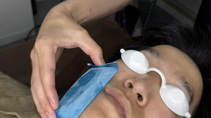 ヒゲ脱毛中に肌を冷却して痛みに配慮している様子
