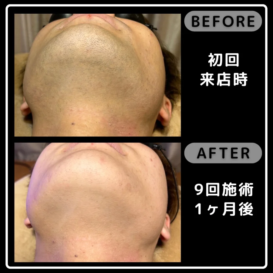 ヒゲ脱毛の初回来店時と9回施術1ヶ月後を比較したあご下の写真