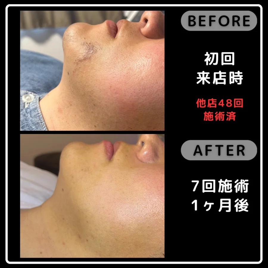 他店48回施術後の初回来店時とReyzの7回施術1ヶ月後を比較した頬の写真