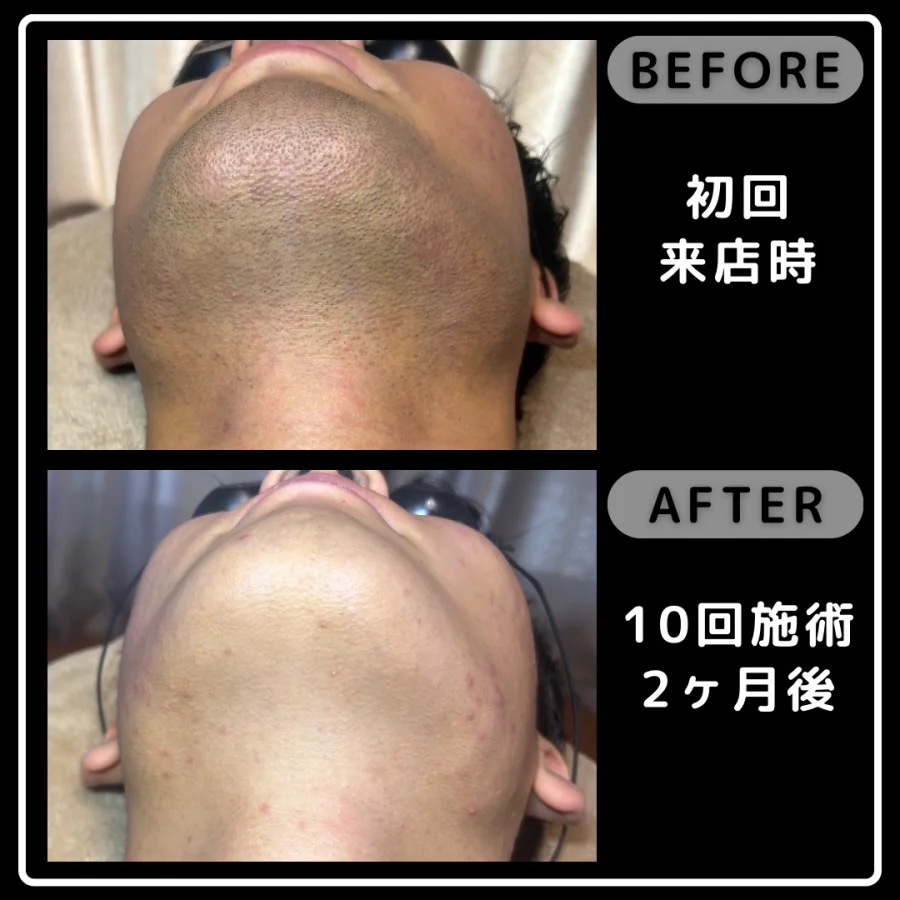 ヒゲ脱毛の初回来店時と10回施術2ヶ月後を比較したあご下の写真