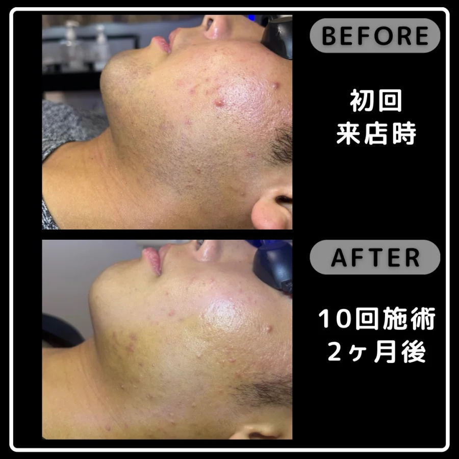 ヒゲ脱毛の初回来店時と10回施術2ヶ月後を比較した頬の写真