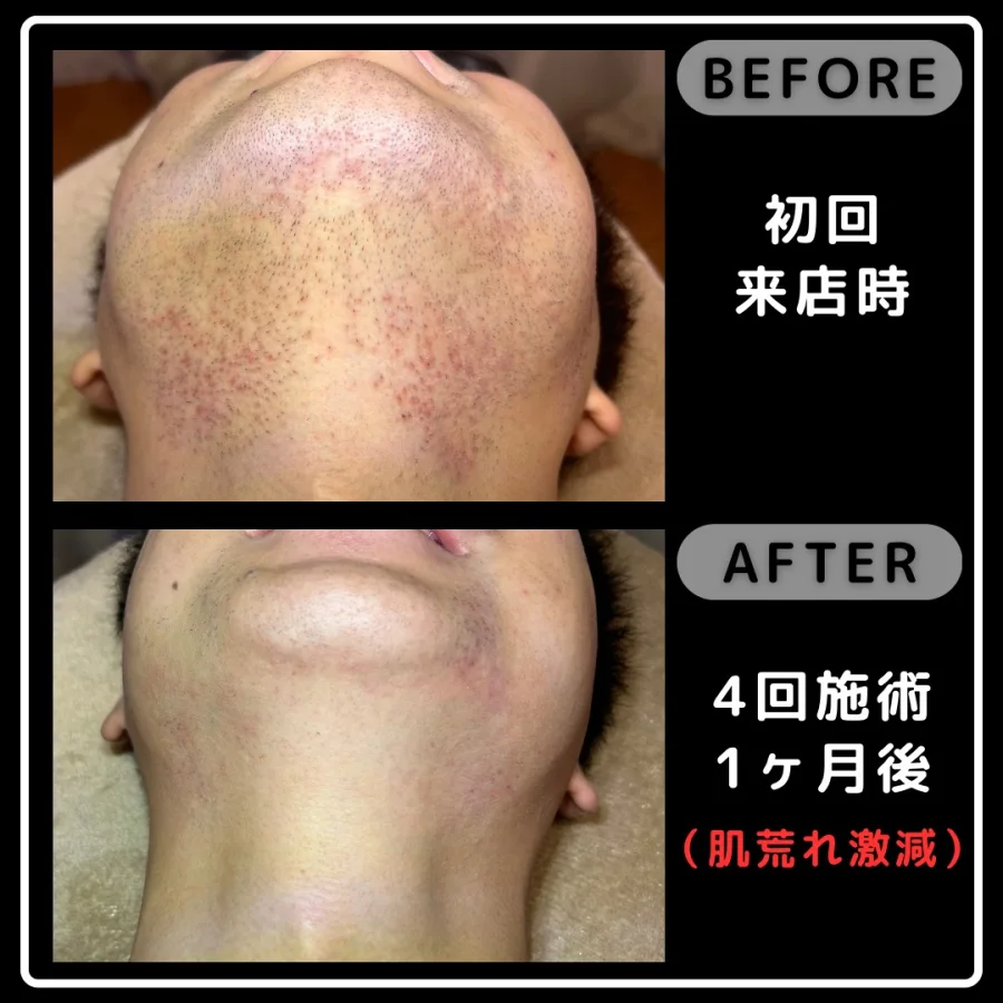 ヒゲ脱毛の初回来店時と4回施術1ヶ月後を比較したあご下の写真