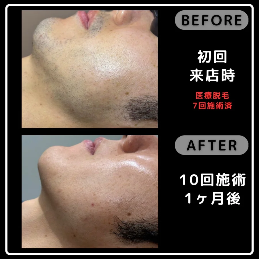 医療脱毛7回施術後の初回来店時とReyzの10回施術1ヶ月後を比較した頬の写真
